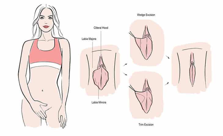 Genital Rejuvenation