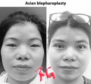 blepharoplasty