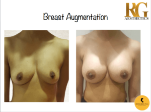 Breast Augmentation
