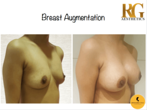 Breast Augmentation