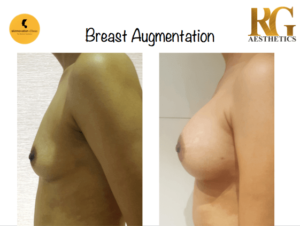 Breast Augmentation