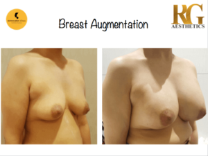 Breast Augmentation