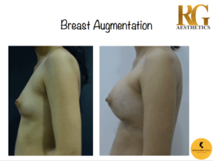 Breast Augmentation