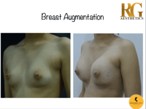 Breast Augmentation