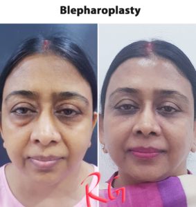 blepharoplasty