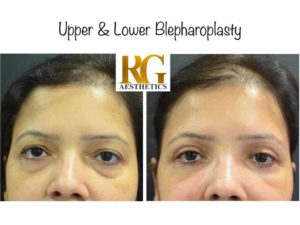 blepharoplasty