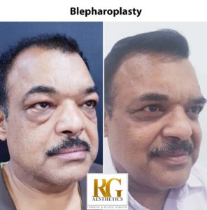 blepharoplasty