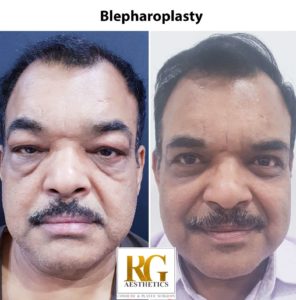 blepharoplasty