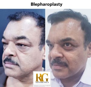 blepharoplasty