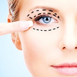 blepharoplasty
