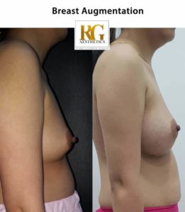 Breast Augmentation