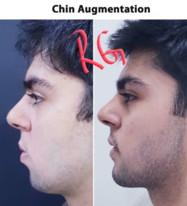 chin augmentation