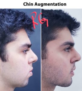 chin augmentation