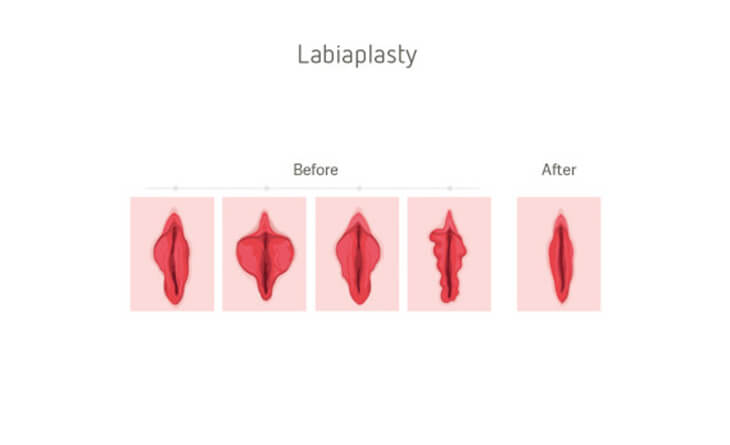 Vaginal Tightening Procedure