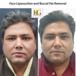 Liposuction surgery