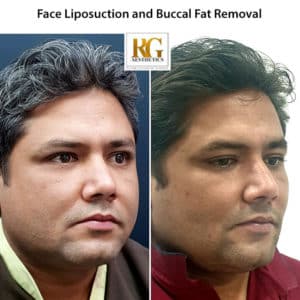 Liposuction surgery
