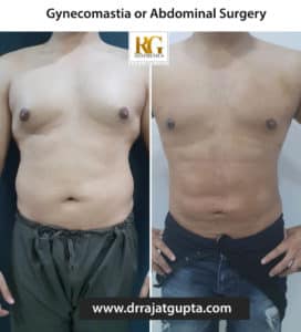 Liposuction surgery