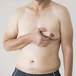 Gynecomastia Surgery in Delhi