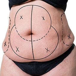 Liposuction Surgery in Delhi
