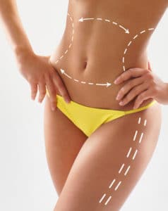 Liposuction surgery