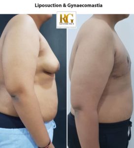 Liposuction surgery