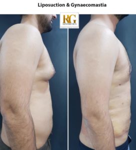 Liposuction surgery