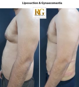 Liposuction surgery