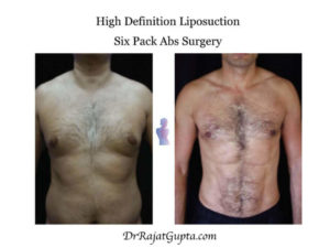 Liposuction surgery