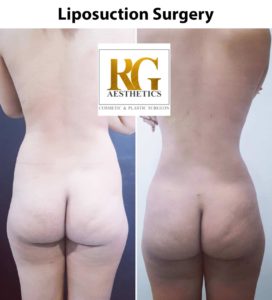 Liposuction surgery
