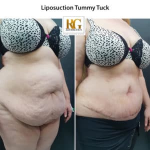 Liposuction surgery