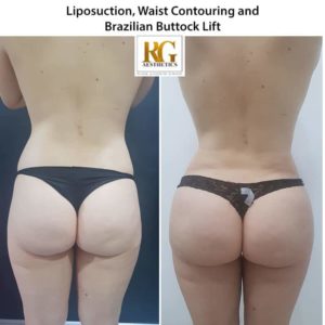 Liposuction surgery