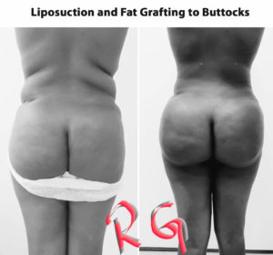 Liposuction surgery