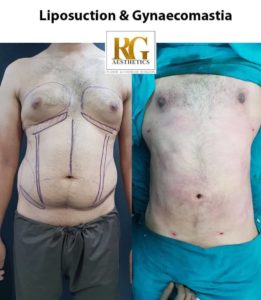 Liposuction surgery