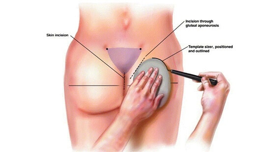 Buttock Augmentation in Delhi