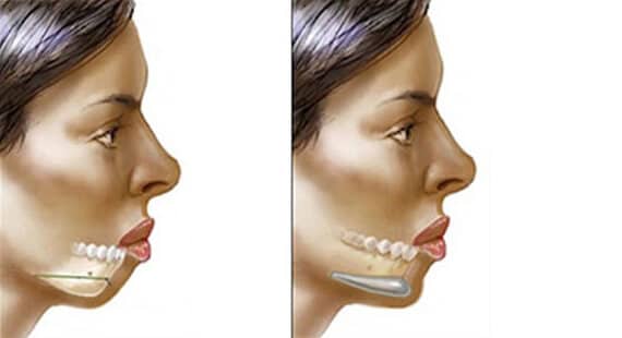 chin augmentation