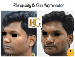 chin augmentation