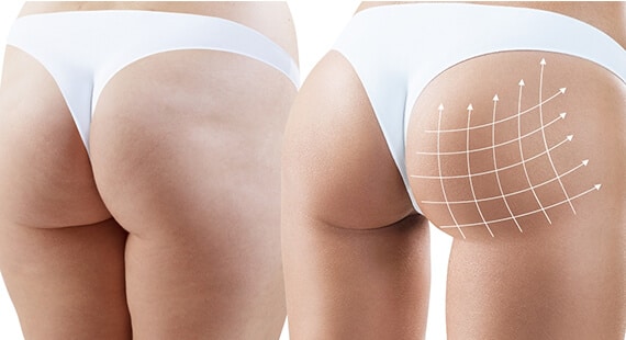 Buttock Augmentation in Delhi