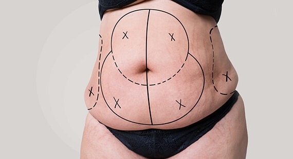 Tummy Tuck Surgery in Delhi, Tummy tuck recovery, Tummy Tuck Surgery cost, Abdominoplasty Surgeon in Delhi, Tummy Tuck surgery before and after, abdominoplasty surgery in Delhi