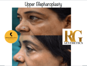 blepharoplasty