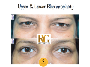 blepharoplasty