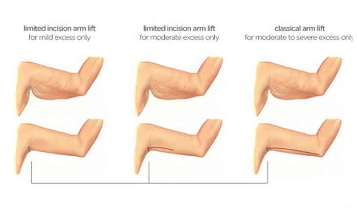 Arm Lift Surgery Procedure