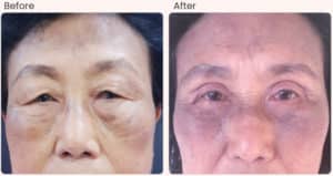 blepharoplasty