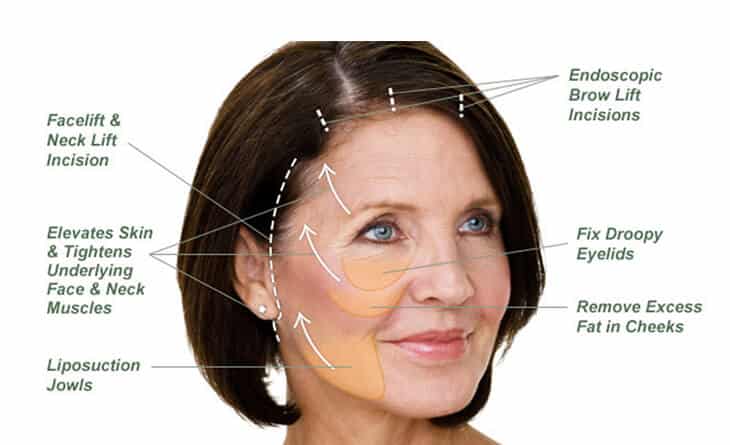 Face Lift Surgery Procedure