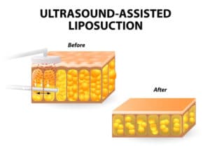 Liposuction surgery