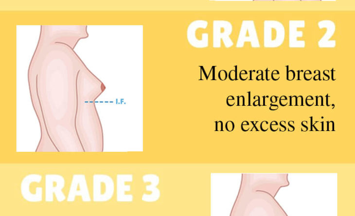 Gynecomastia Grades (1) Gynecomastia Grades (1)