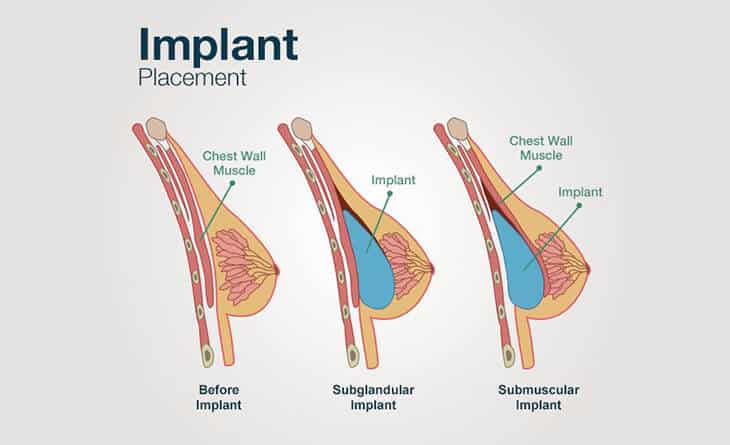Breast Augmentation
