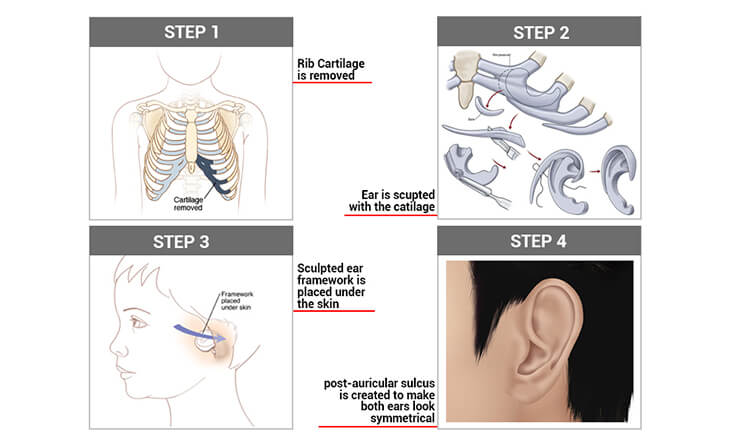 Microtia