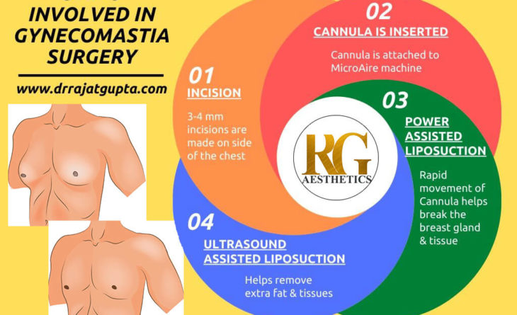 gynecomastia 2 (1) gynecomastia 2 (1)