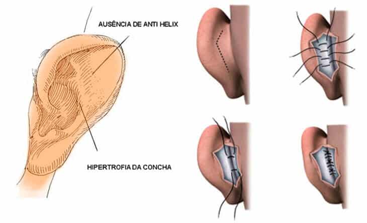 Otoplasty