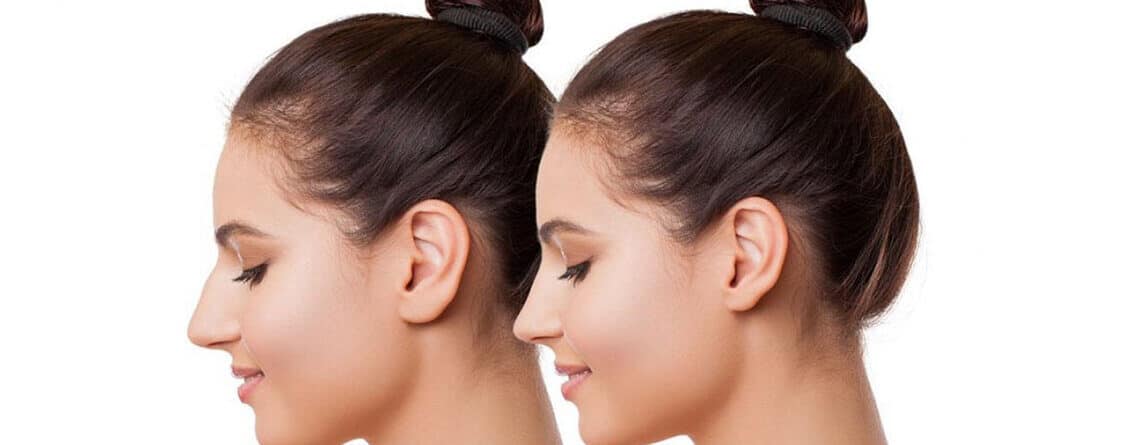 Otoplasty